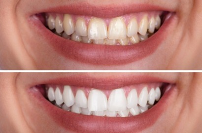 Quer um Sorriso Brilhante? Descubra o Segredo do Clareamento Dental!