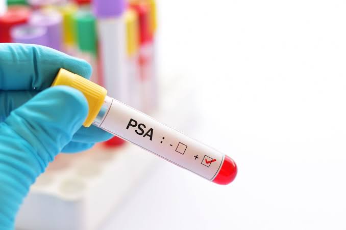 Câncer de próstata: importância do PSA e do USG no diagnóstico