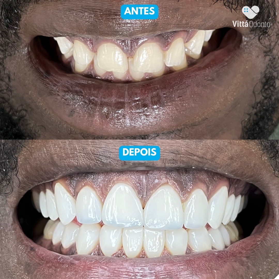 Facetas de Porcelana: Vantagens, Benefícios e Tudo o Que Você Precisa Saber