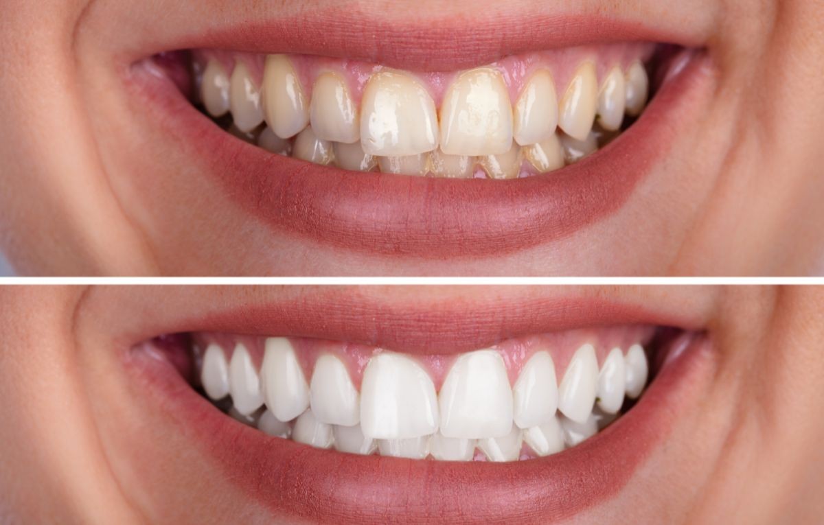 Quer um Sorriso Brilhante? Descubra o Segredo do Clareamento Dental!