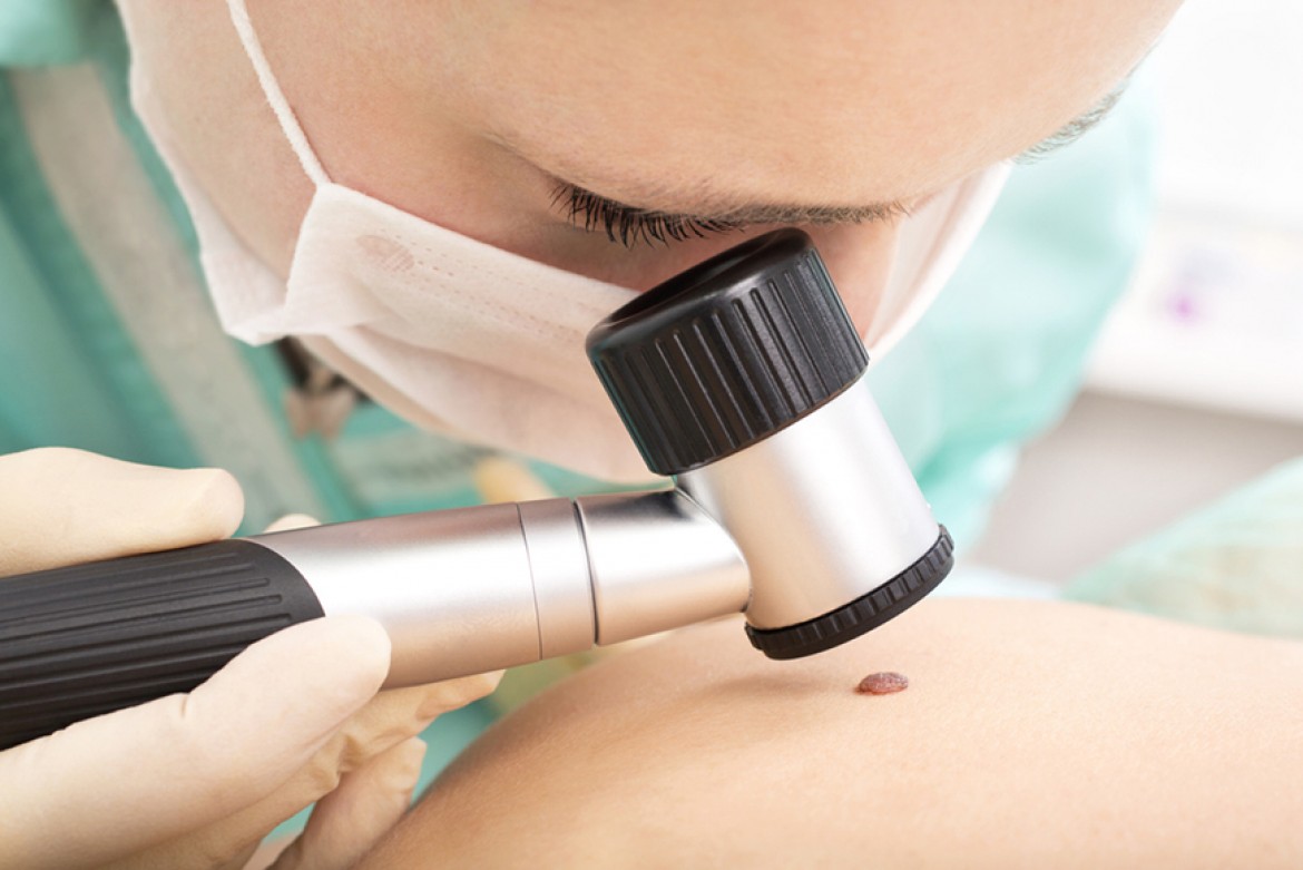 Entenda a importância da biópsia para o diagnóstico do câncer de pele