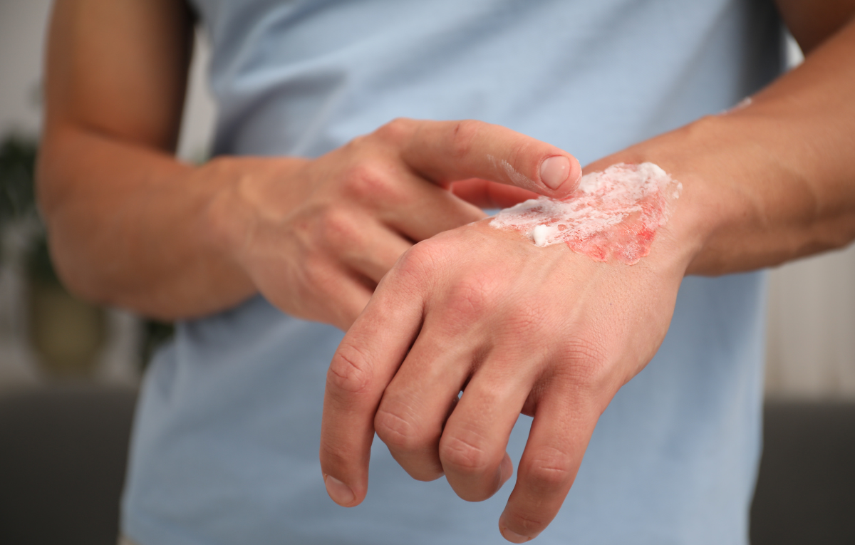 Espirrou Óleo Quente na Pele? O Que Passar na Queimadura e o Que NUNCA Usar